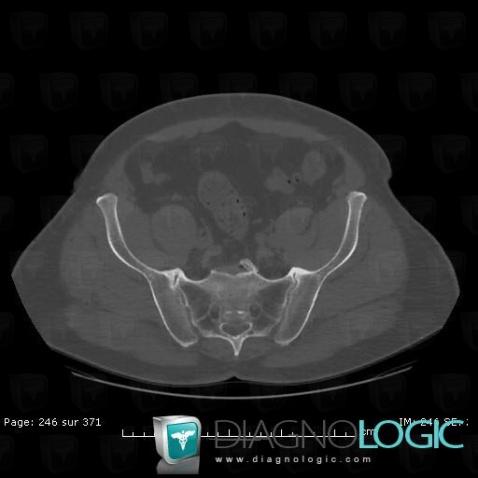 Arthrose, Articulation sacro iliaque, TDM