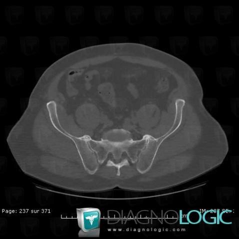 Arthrose, Articulation sacro iliaque, TDM