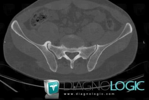 Arthrose, Articulation sacro iliaque, TDM