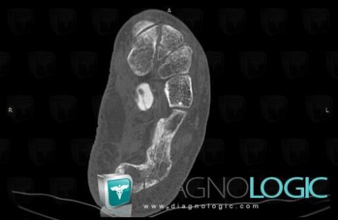 Radiology case Degenerative joint disease CT Diagnologic