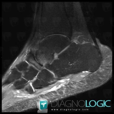 Arthrose, Talus, Os naviculaire, IRM