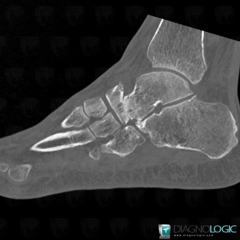 Arthrose, Talus, Os naviculaire, Scanner