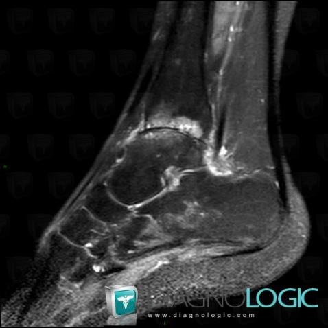 Arthrose, Tibia -inférieur, Articulation tibio /fibulo talienne, IRM