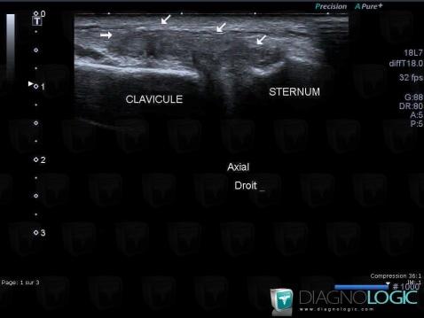 Articulation Costo-sternale / Sterno-claviculaire et Cartilage chondrocostal, Echographie