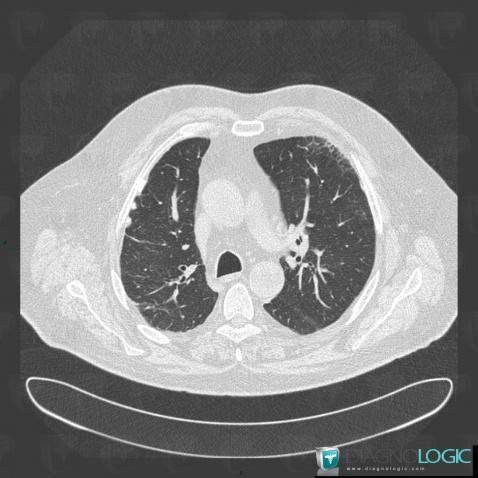 Asbestose, Parenchyme pulmonaire, Scanner