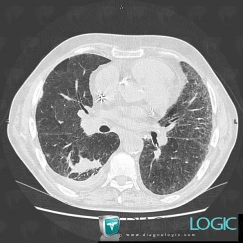 Asbestose, Parenchyme pulmonaire, Scanner