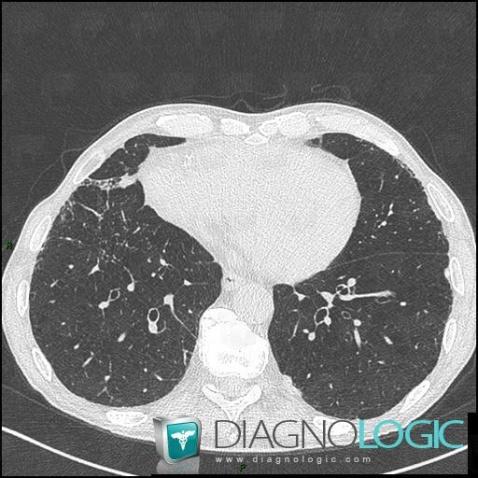 Asbestosis, Airways, CT