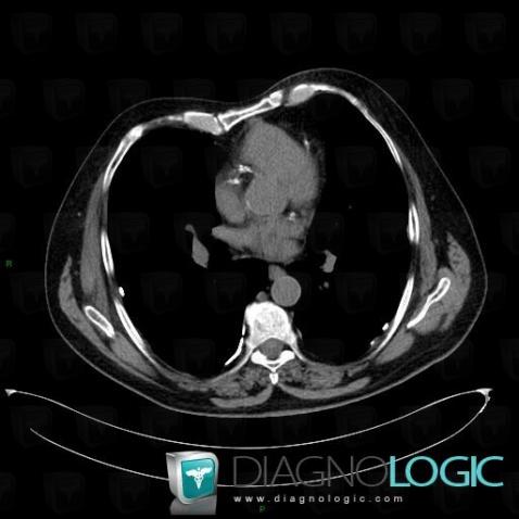 Asbestosis, Pleura, CT