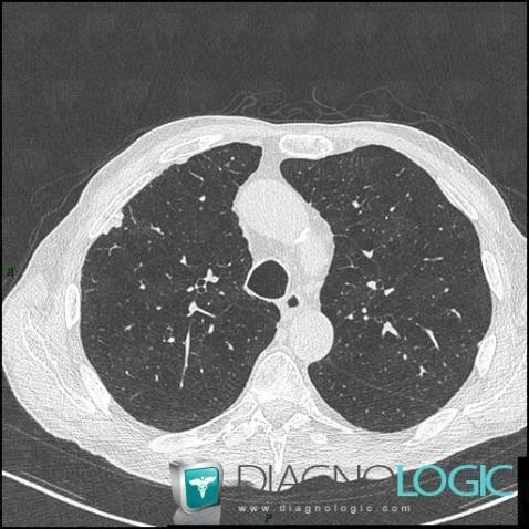 Asbestosis, Pleura, CT