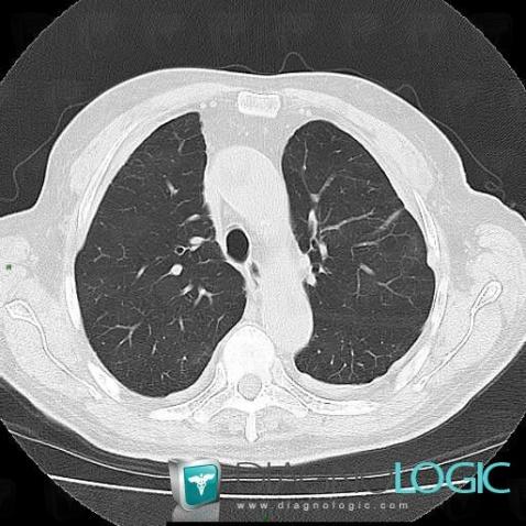 Radiology case : Asbestosis (CT) - Diagnologic