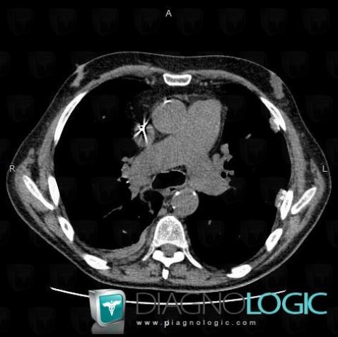 Asbestosis, Pleura, CT