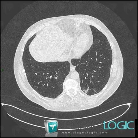 Asbestosis, Pulmonary parenchyma, CT