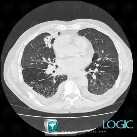 Asbestosis, Pulmonary parenchyma, CT