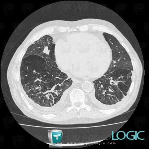 Asbestosis, Pulmonary parenchyma, CT