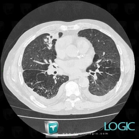 Asbestosis, Pulmonary parenchyma, CT