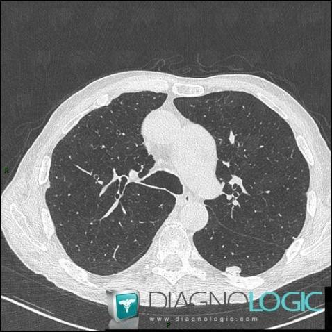 Asbestosis, Pulmonary parenchyma, CT