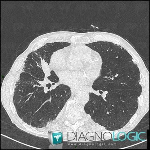 Asbestosis, Pulmonary parenchyma, CT