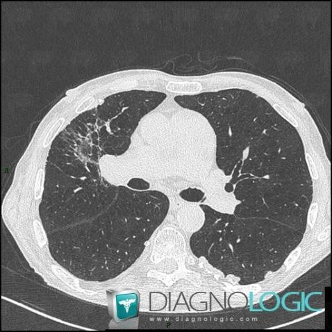 Asbestosis, Pulmonary parenchyma, CT