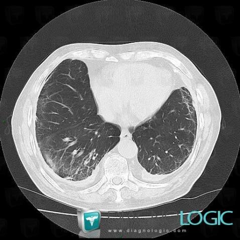 Asbestosis, Pulmonary parenchyma, CT