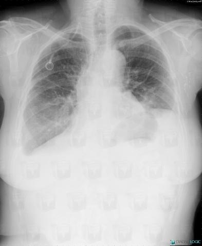 Ascites, Diaphragm, X rays