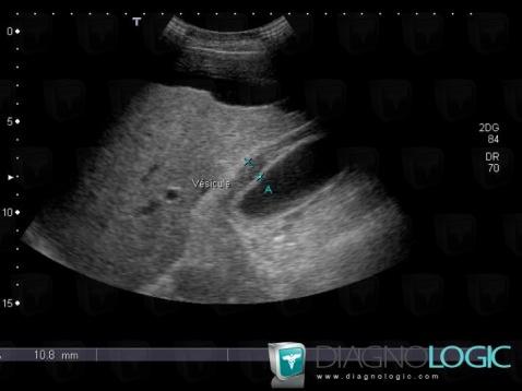 Ascites, Gallbladder, US