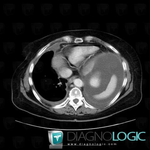 Ascites, Mesentery / Peritoneum, CT