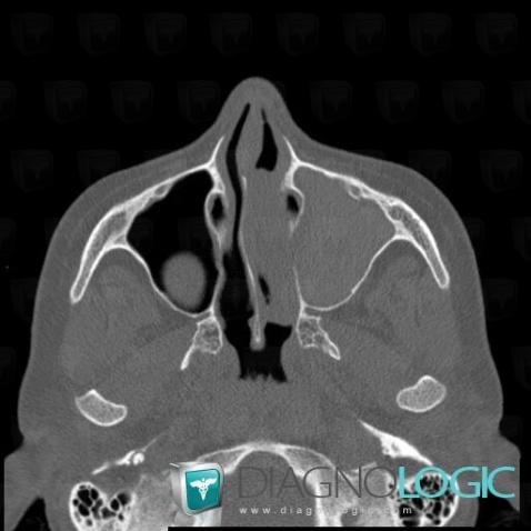 Aspergillose, Fosses nasales / Nasopharynx, Scanner