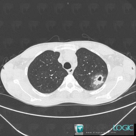 Aspergillose, Parenchyme pulmonaire, Scanner