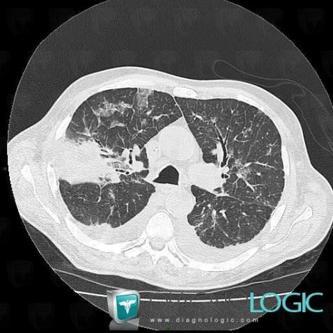 Aspergillose, Parenchyme pulmonaire, Scanner