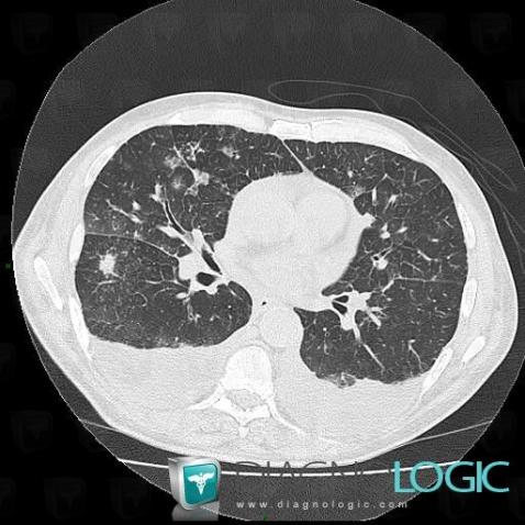 Aspergillose, Parenchyme pulmonaire, Scanner