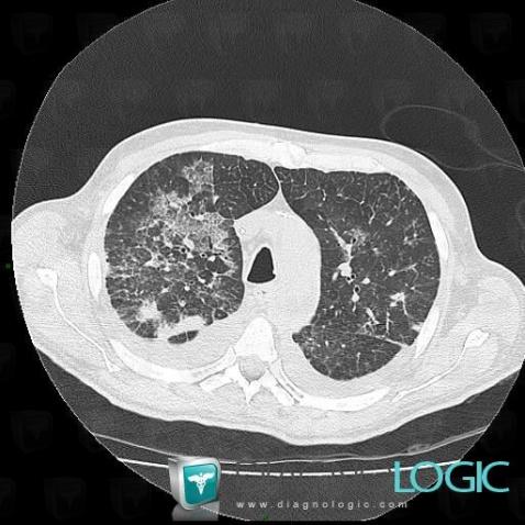 Aspergillose, Parenchyme pulmonaire, Scanner