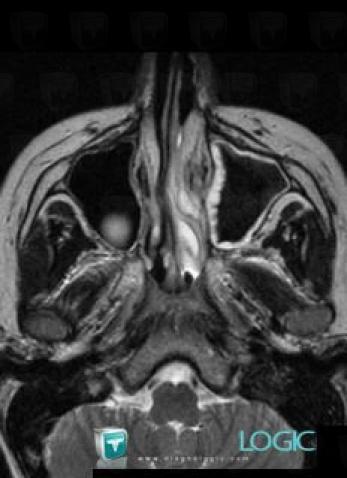 Aspergillose, Sinus, IRM