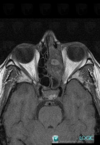 Aspergillose, Sinus, IRM