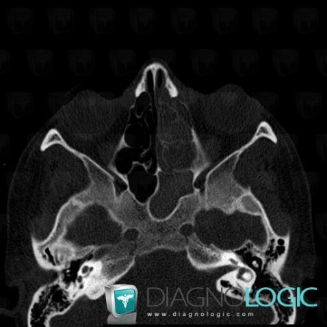 Aspergillose, Sinus, Scanner