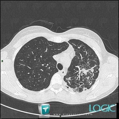 Aspergillosis, Airways, CT