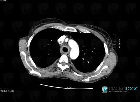 Aspergillosis, Airways, CT