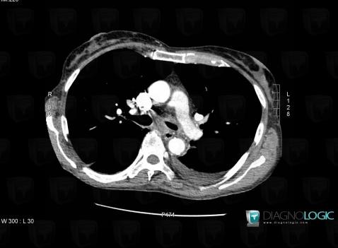 Aspergillosis, Airways, CT