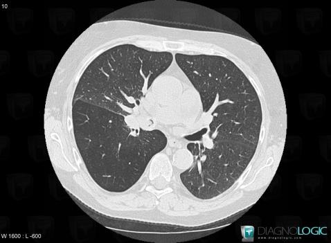 Aspergillosis, Pulmonary parenchyma, Airways, CT