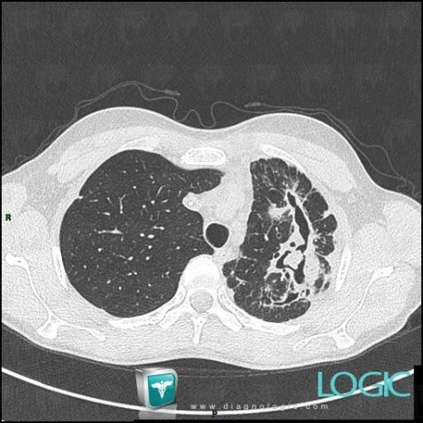 Aspergillosis, Pulmonary parenchyma, CT