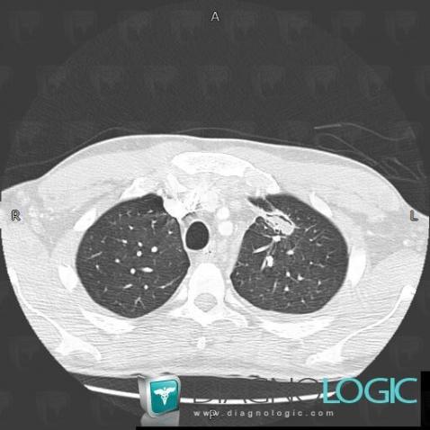 Aspergillosis, Pulmonary parenchyma, CT