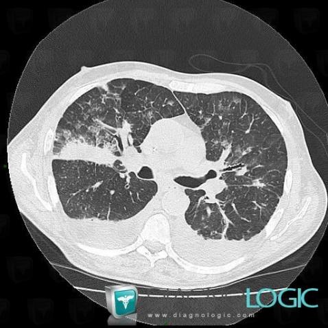 Aspergillosis, Pulmonary parenchyma, CT