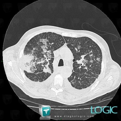 Aspergillosis, Pulmonary parenchyma, CT