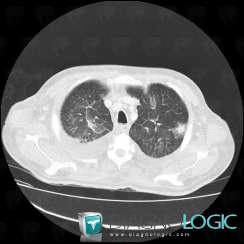 Aspergillosis, Pulmonary parenchyma, CT