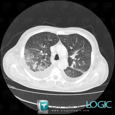 Aspergillosis, Pulmonary parenchyma, CT