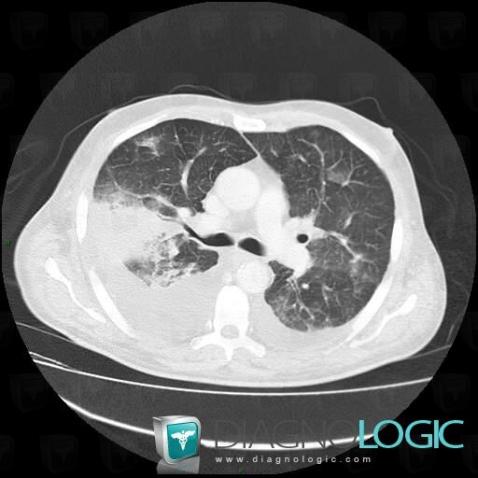 Aspergillosis, Pulmonary parenchyma, CT