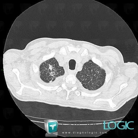 Aspergillosis, Pulmonary parenchyma, CT