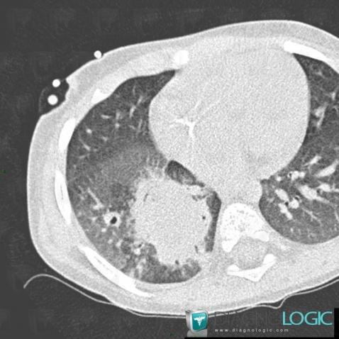 Aspergillosis, Pulmonary parenchyma, CT