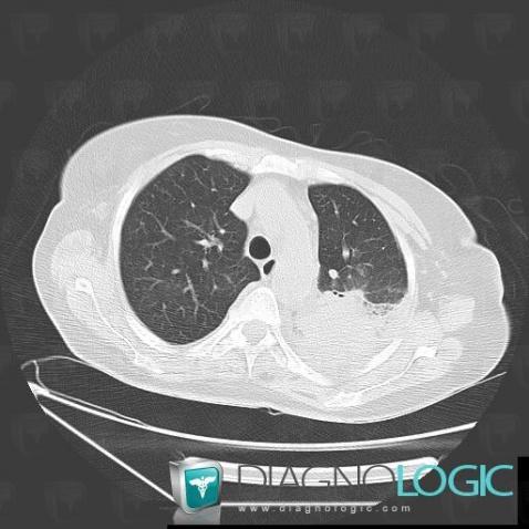 Aspergillosis, Pulmonary parenchyma, CT