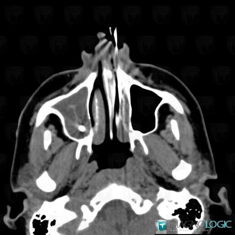 Aspergillosis, Sinus, CT