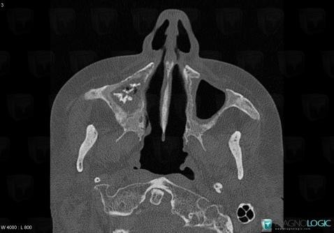 Aspergillosis, Sinus, CT